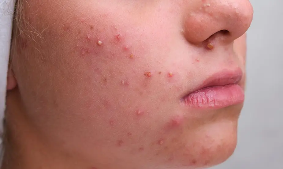 Common Triggers of Acne