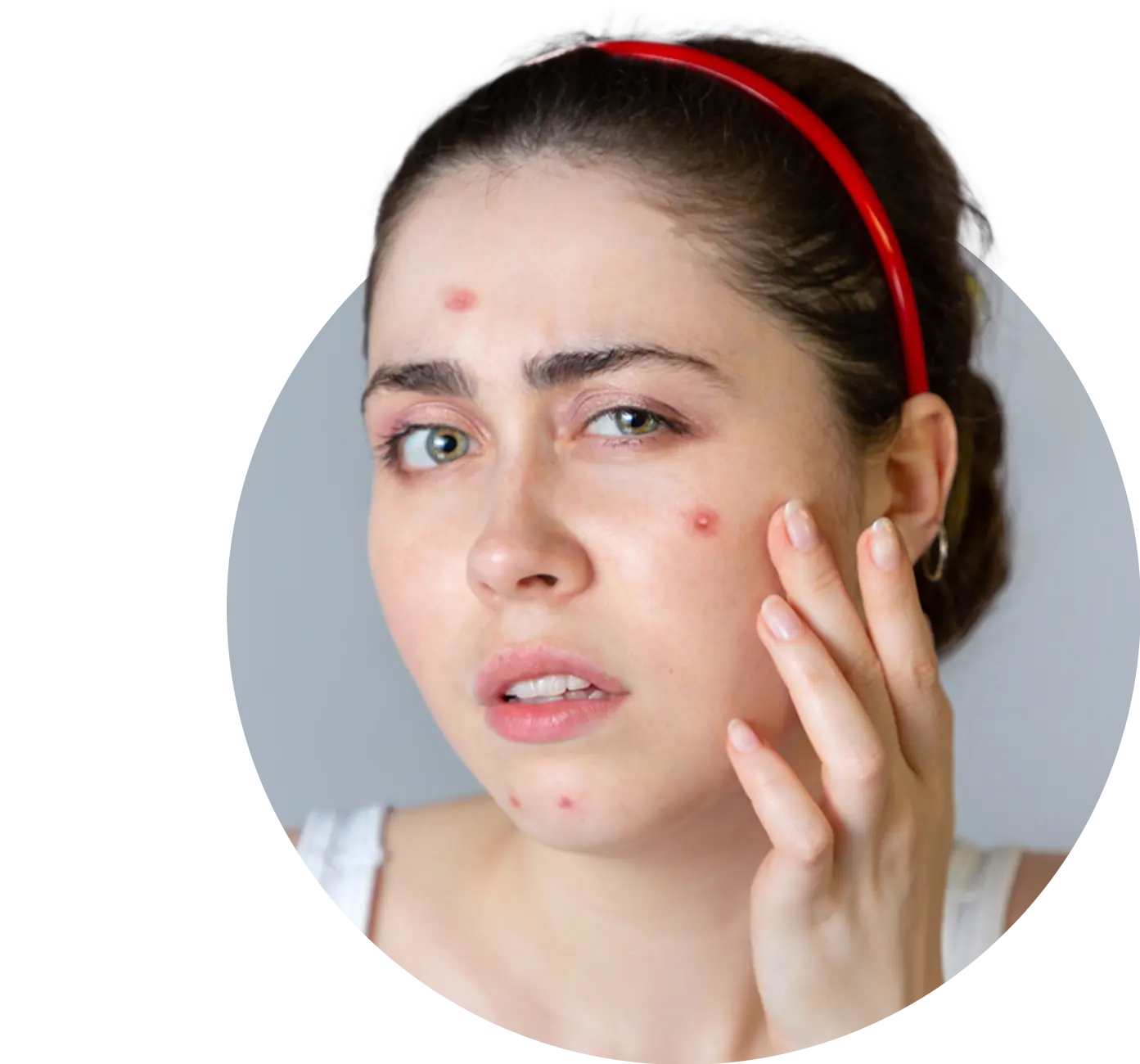 Advanced Homeopathy Treatment for Acne (Pimples)