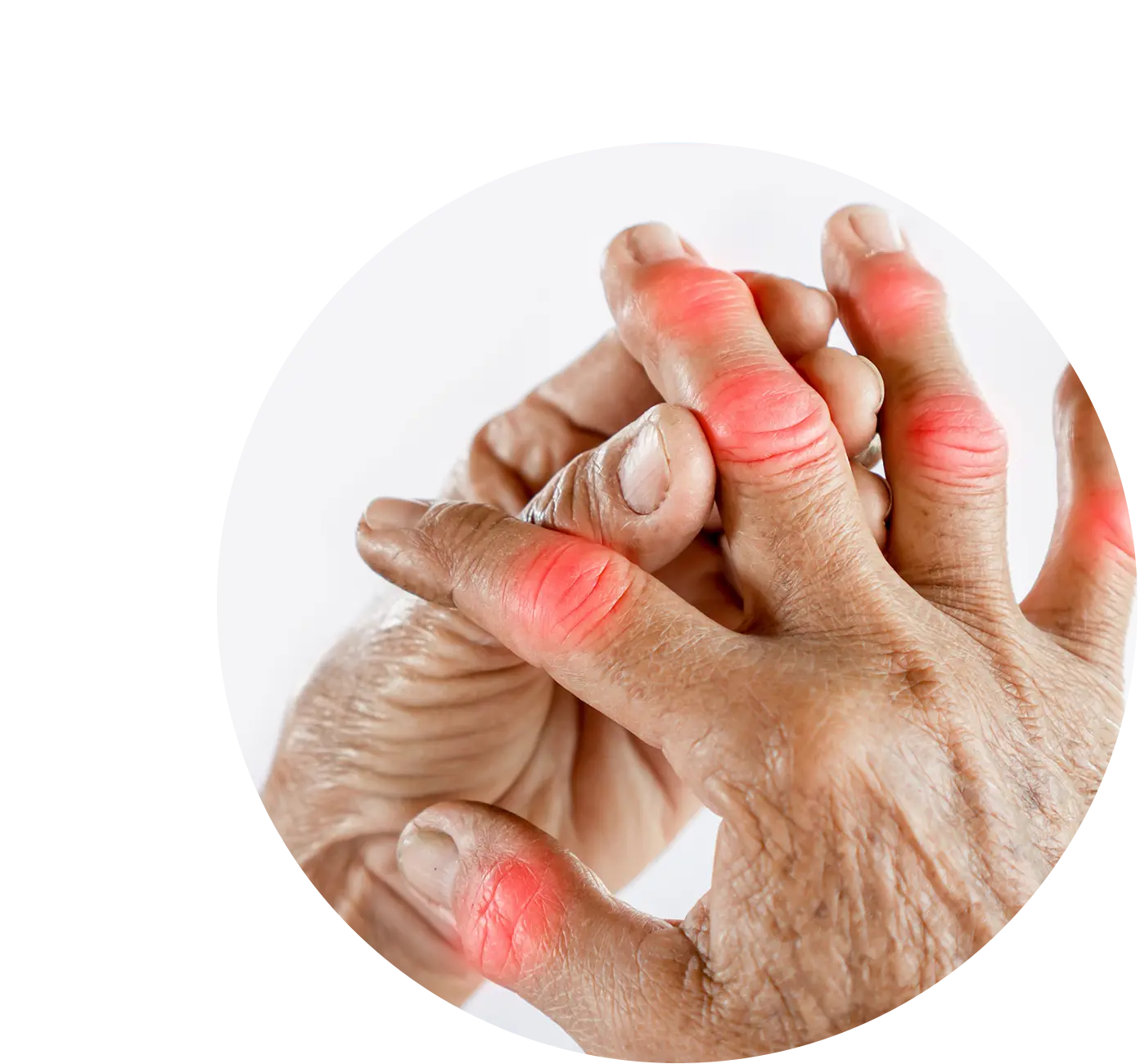 Advanced Homeopathy Treatment for Arthritis