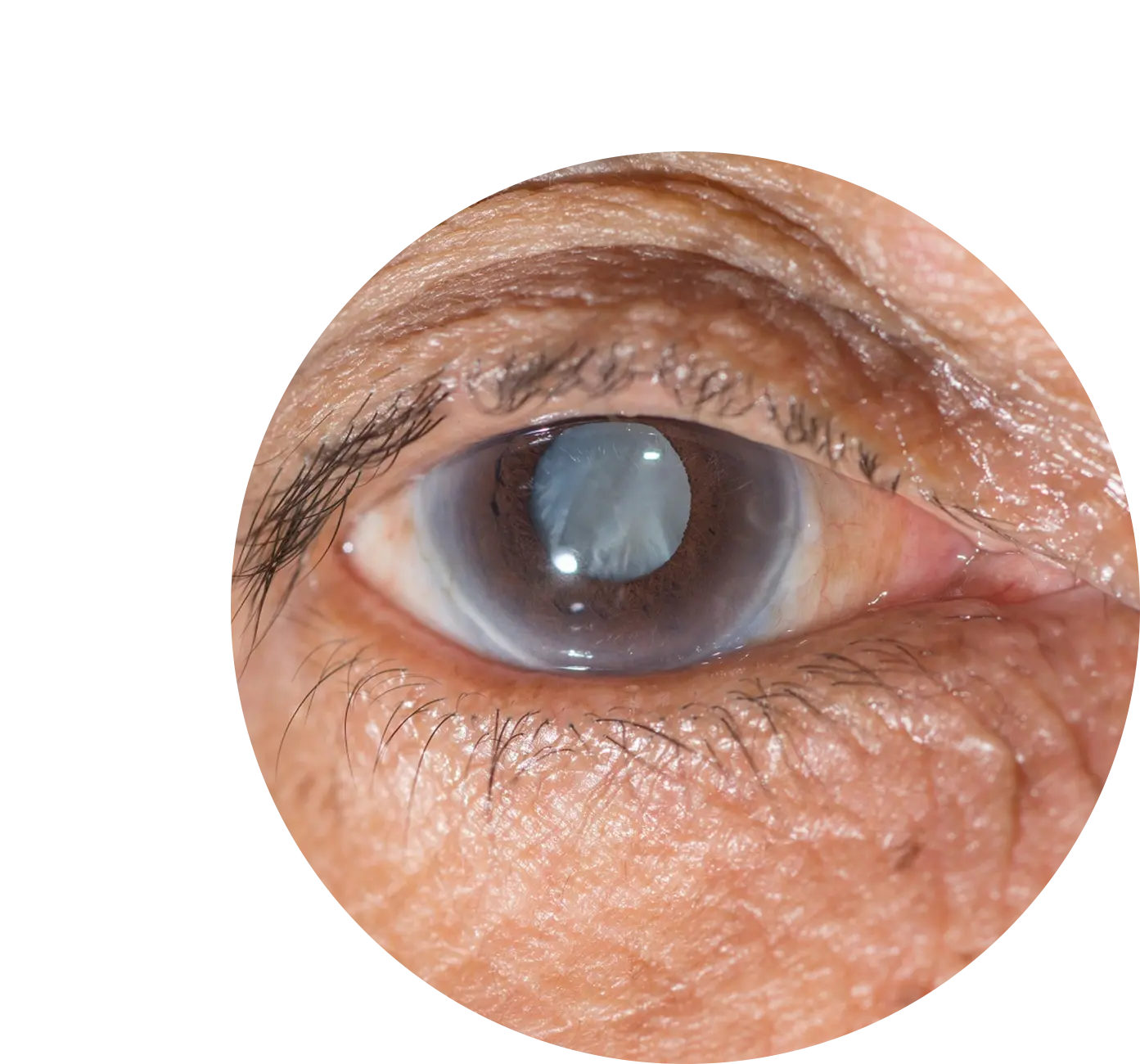 Advanced Homeopathy Treatment for Cataracts