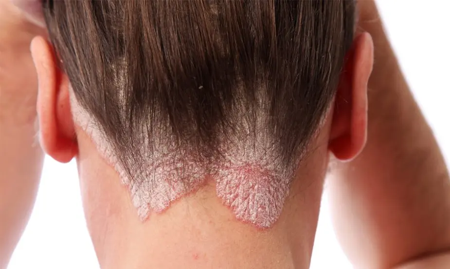 Common Triggers of Psoriasis