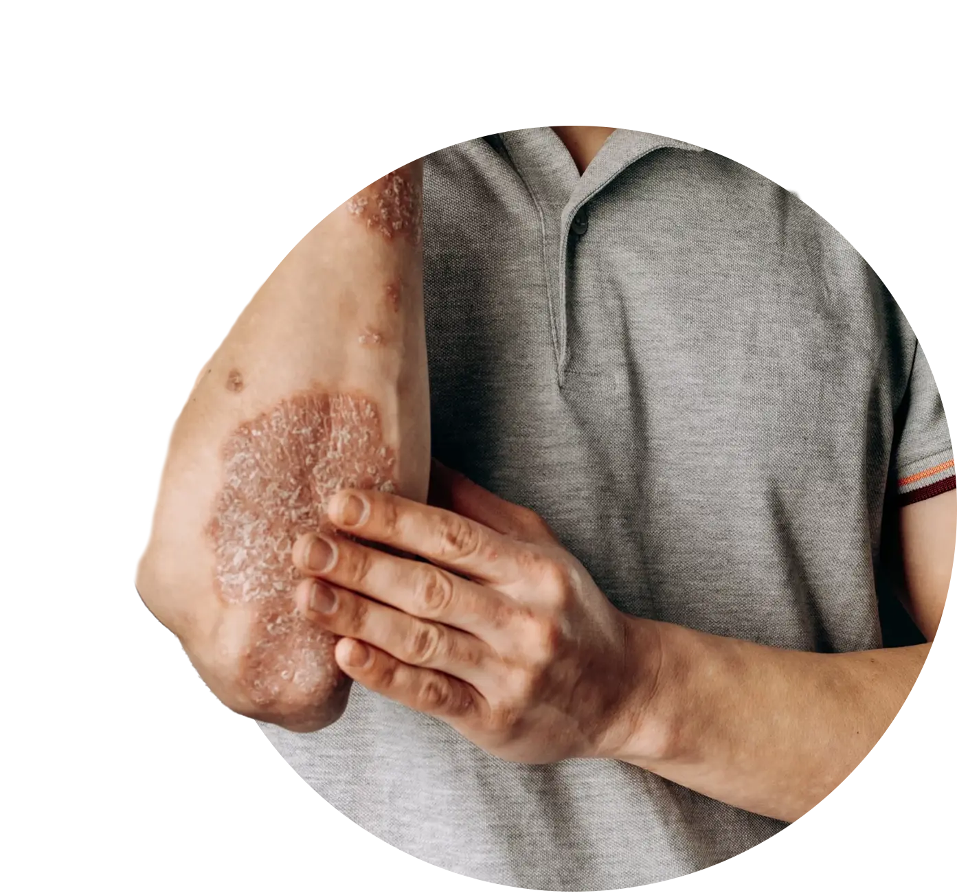 Advanced Homeopathy Treatment for Eczema