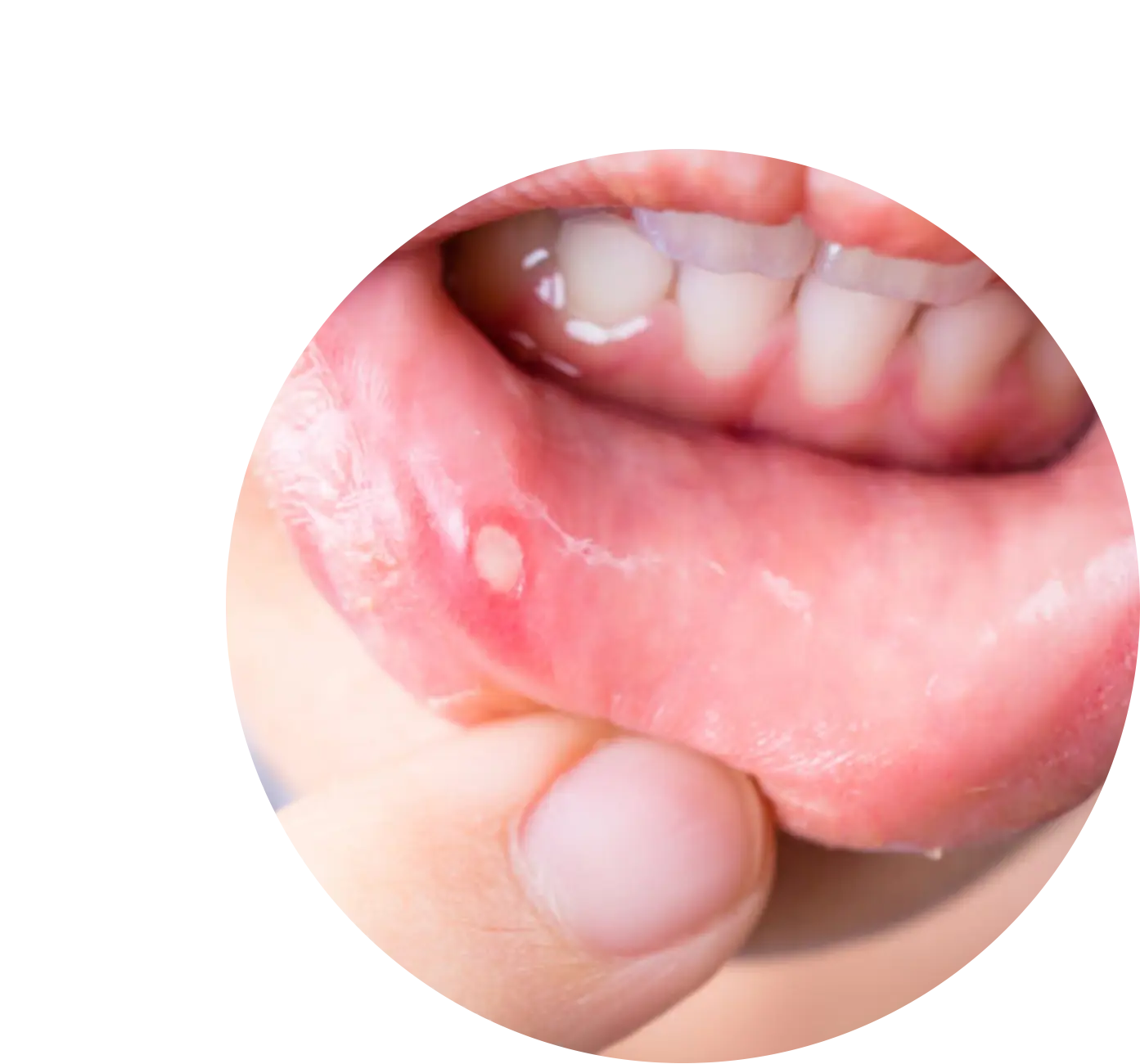 Advanced Homeopathy Treatment for Ulcer