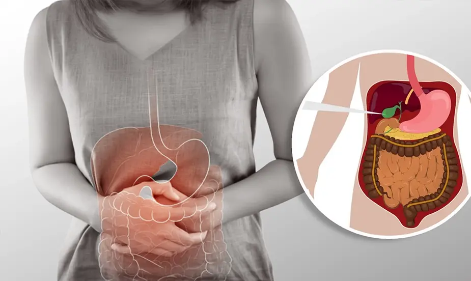 Common Triggers of Gallbladder Stone