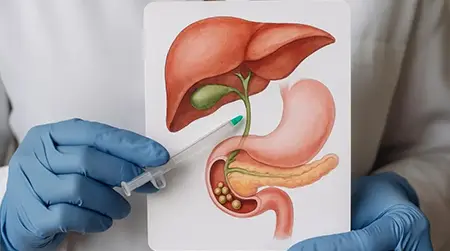 How to Prevent Gallbladder Stones?