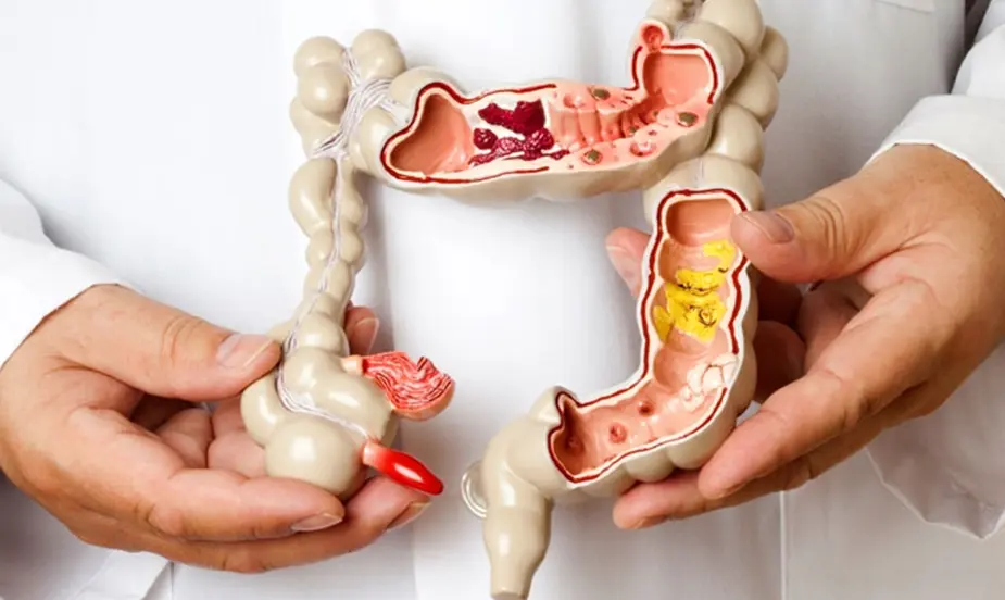 Common Triggers of Irritable Bowel Syndrome (IBS)