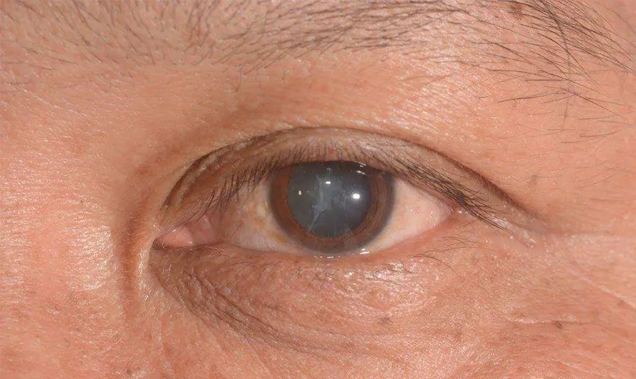 How to Prevent Cataracts?