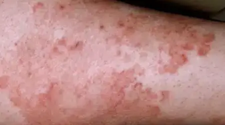 How to Prevent Ringworm?