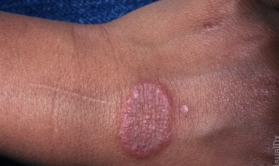 Common Triggers of Ringworm