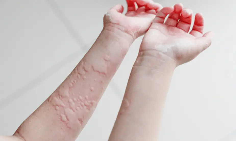 Common Triggers of Skin Allergy