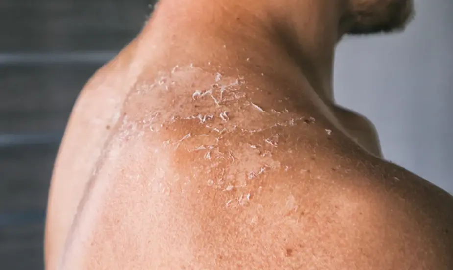 How to Prevent Skin Allergy?