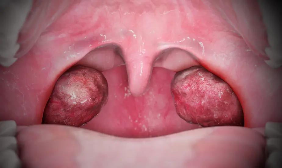 How to Prevent Tonsil Infections