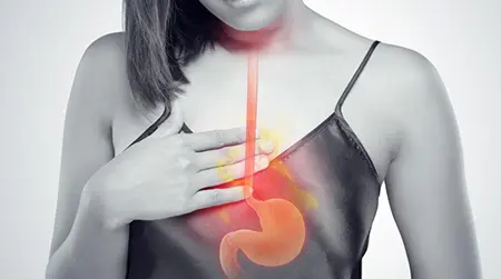 Acid Reflux