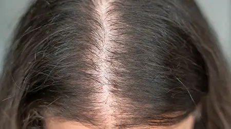 Hair Thinning