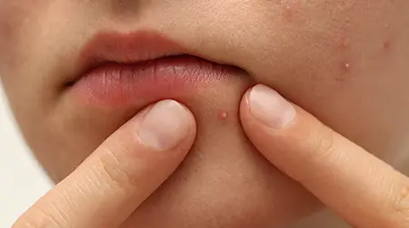 Pus Filled Pimples
