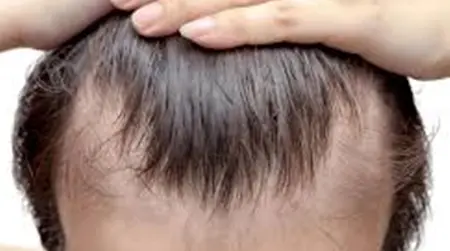 Receding Hairline