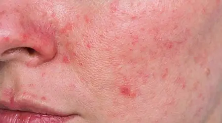 Red Pimples