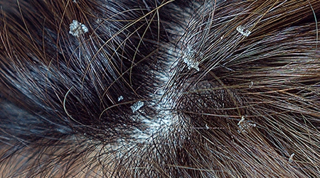 Scalp Flakes