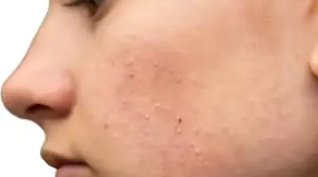 Small bumps