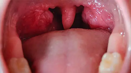 Swollen Tonsils