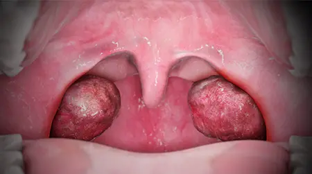Acute Tonsillitis
