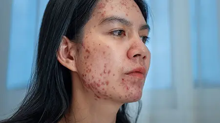 Adult Acne