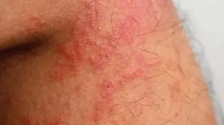 Atopic  Eczema