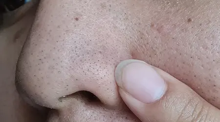 Blackhead Acne
