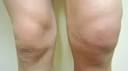 Bursitis Knee
