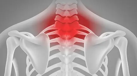 Cervical Spondylosis