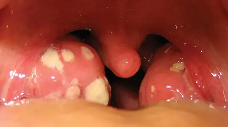 Chronic Tonsillitis
