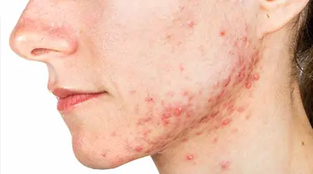 Cystic Acne