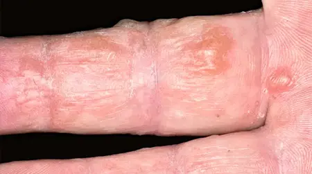 Dyshidrotic  Eczema