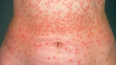 Guttate   Psoriasis