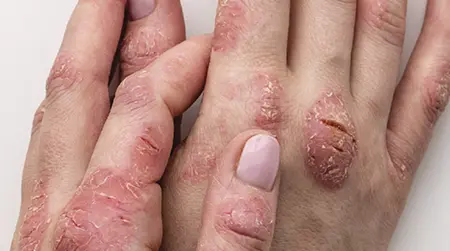 Hand  Eczema
