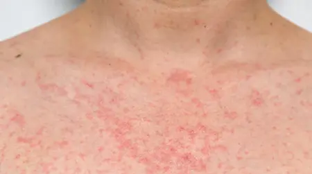 Heat  Rash