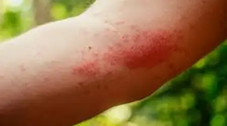 Insect Bite  Allergy
