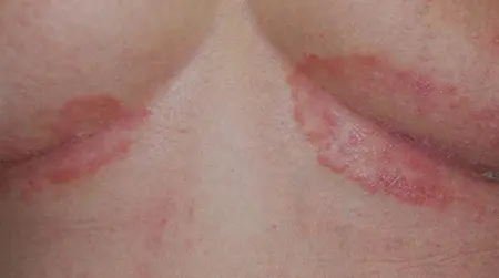 Inverse  Psoriasis