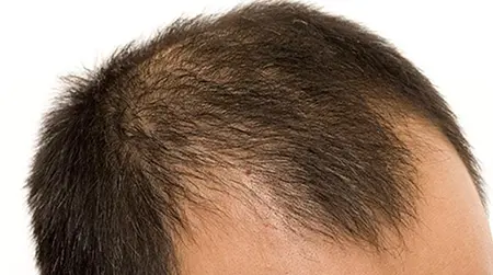 Male Pattern Baldness