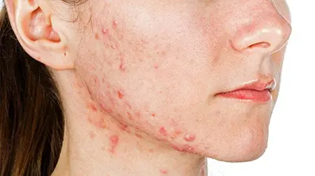 Nodular Acne