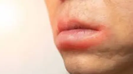 Oral Allergy Syndrome