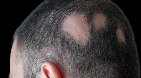 Patchy Hair Loss