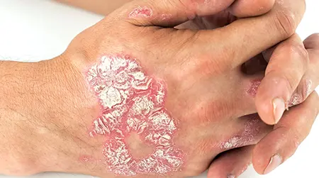 Plaque   Psoriasis