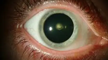 Posterior Cataract