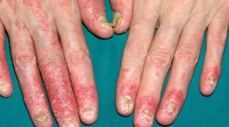 Psoriatic Arthritis
