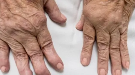 Rheumatoid Arthritis