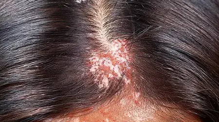 Scalp  Psoriasis