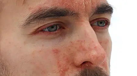 Seborrheic  Dermatitis