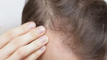 Traction Alopecia