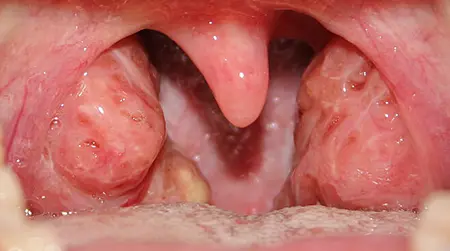 Viral Tonsillitis